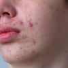 Jerawat di Sekitar Bibir