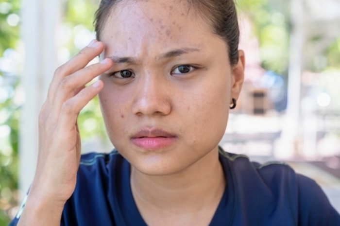 No Worry Lagi Kalau Ada Noda Kehitaman di Wajah!
