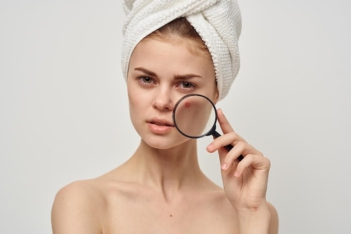 Temukan Do's and Dont's Memakai Acne Patch!